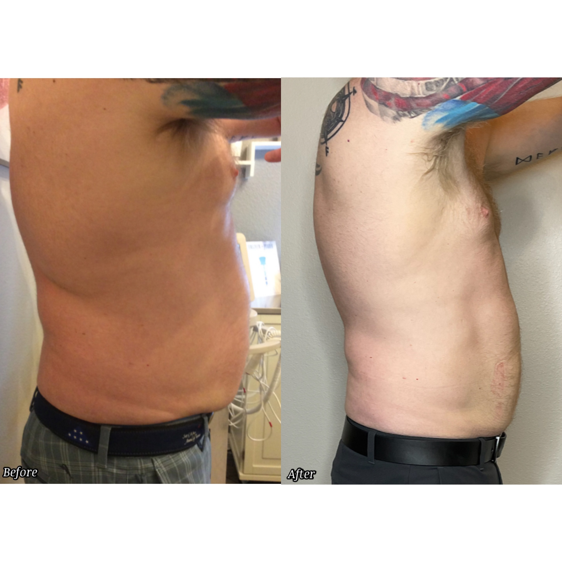 Resultados de Contorno Corporal antes y después