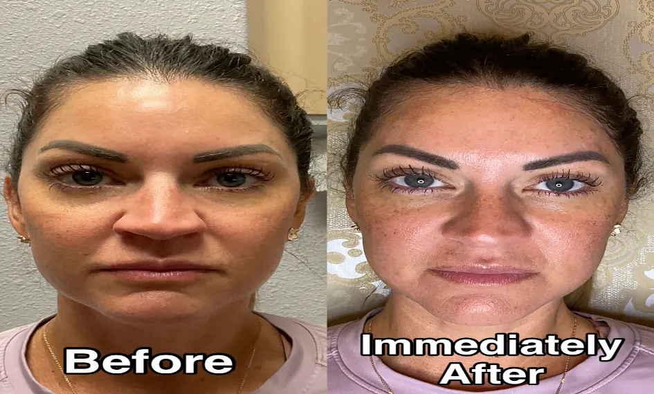 Rellenos Dérmicos (Rostro) antes y después