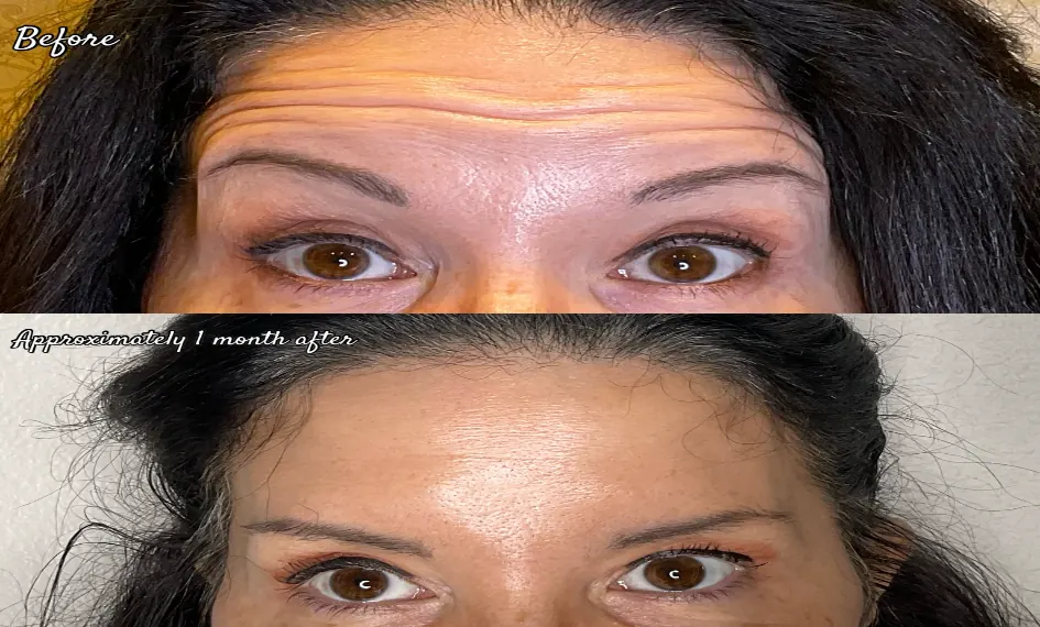 Botox (Líneas de la Frente) antes y después