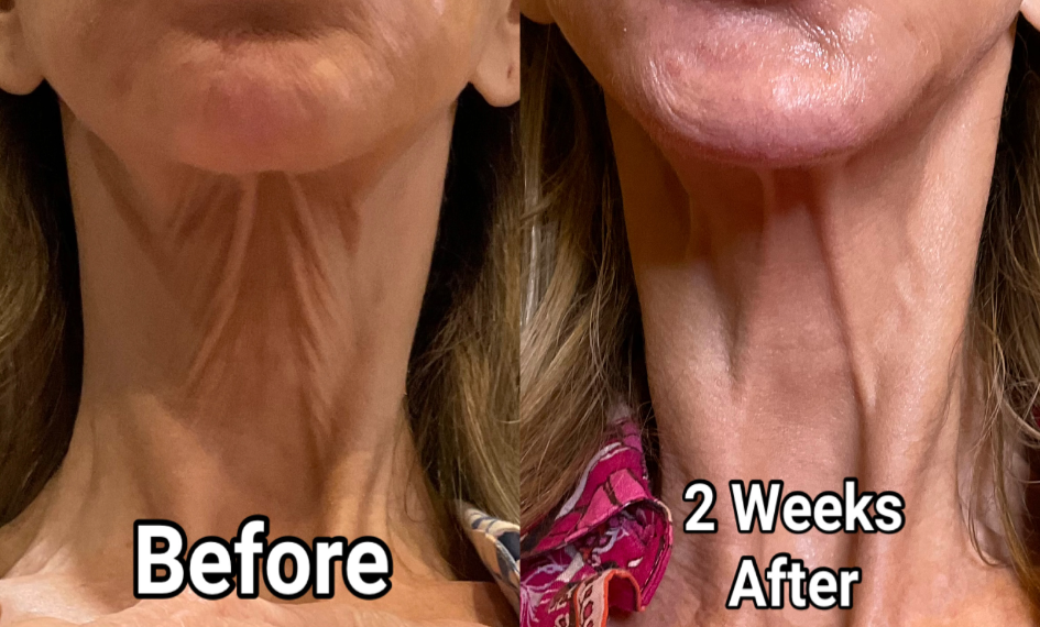 Tensado del Cuello antes y después