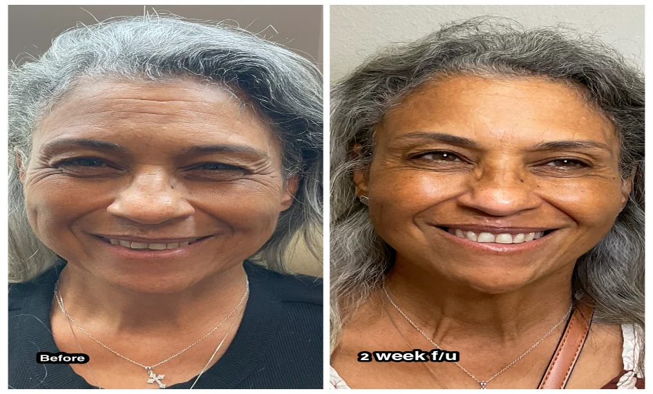 Botox antes y después en el control a las 2 semanas, vista frontal sonriendo: patas de gallo y líneas de la frente suavizadas