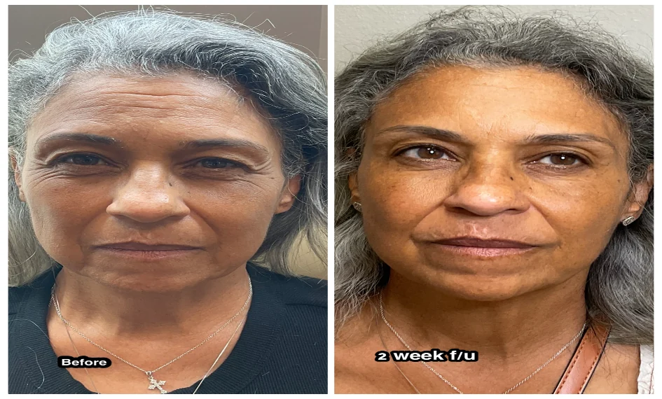 Botox antes y después en el control a las 2 semanas, vista frontal en reposo: líneas de la frente y del entrecejo suavizadas