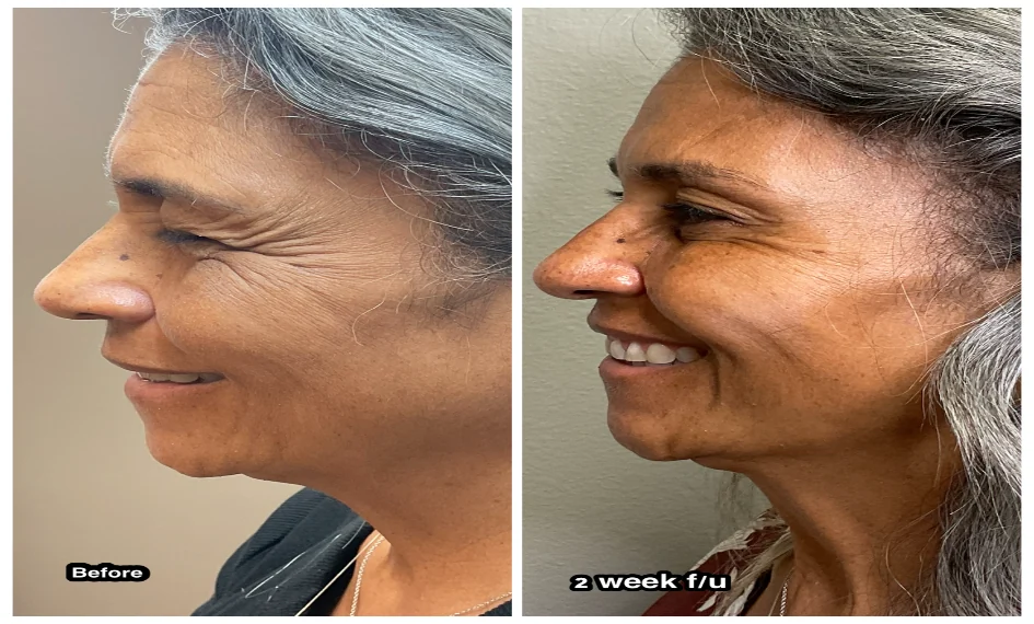 Botox antes y después en el control a las 2 semanas, perfil izquierdo: patas de gallo suavizadas