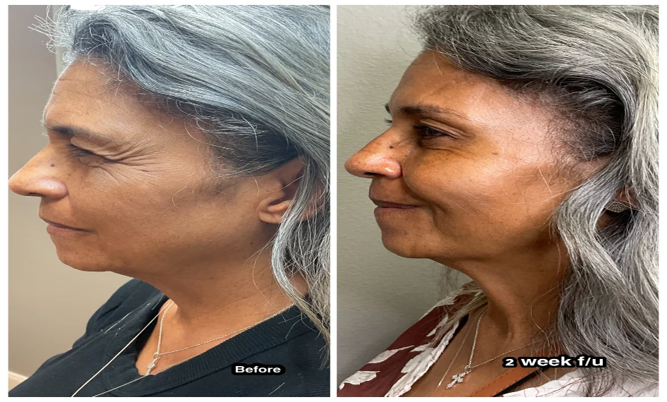 Botox antes y después en el control a las 2 semanas, perfil derecho: patas de gallo suavizadas