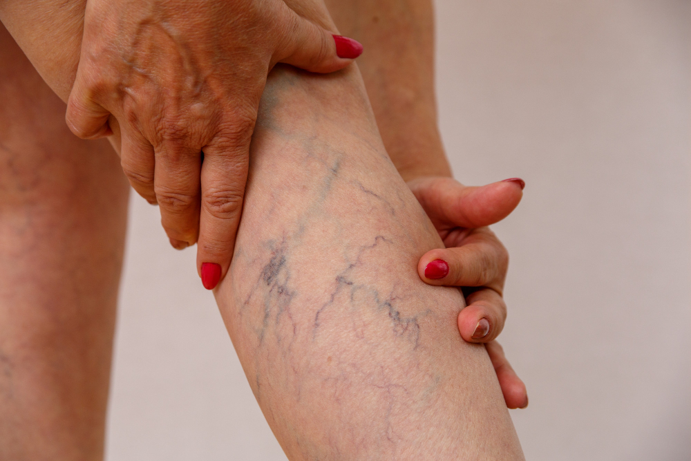 Spider veins 2