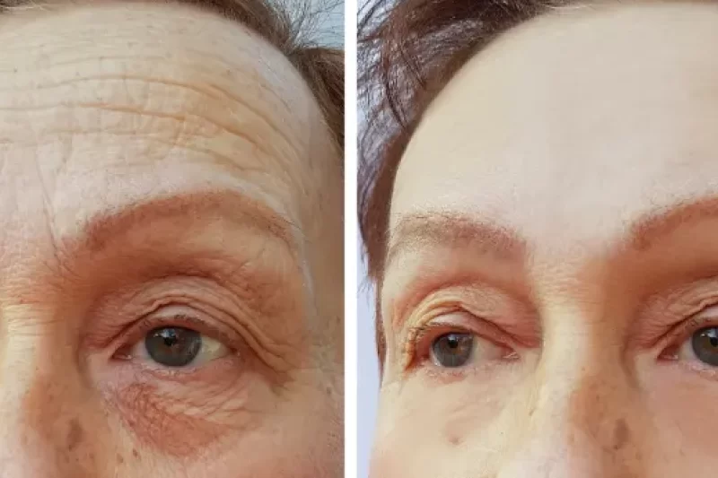 How Long Does Botox Last